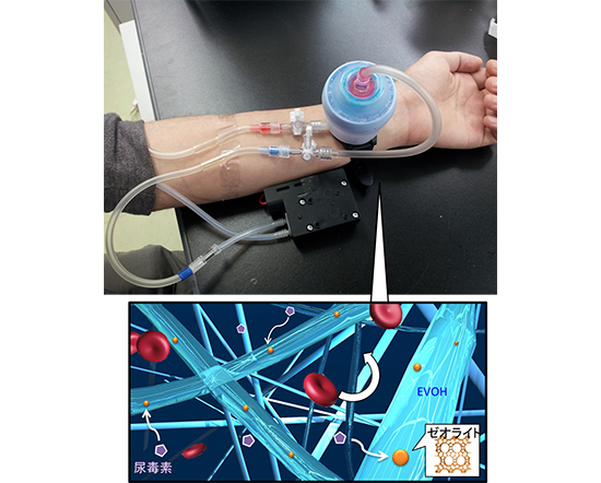 "Figure 1 A wrist-worn uremic toxin removal system that can be used during emergencies when essential utilities, such as electricity and water supplies, are interrupted.  The wrist-worn device is equipped with a nanofiber mesh made of ethylene vinyl alcohol (EVOH) containing zeolite, which is capable of absorbing a uremic toxin." Image