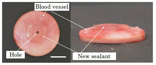 "Figure 1: The newly developed sealant that was applied over a 3-mm-diameter hole in a porcine blood vessel." Image